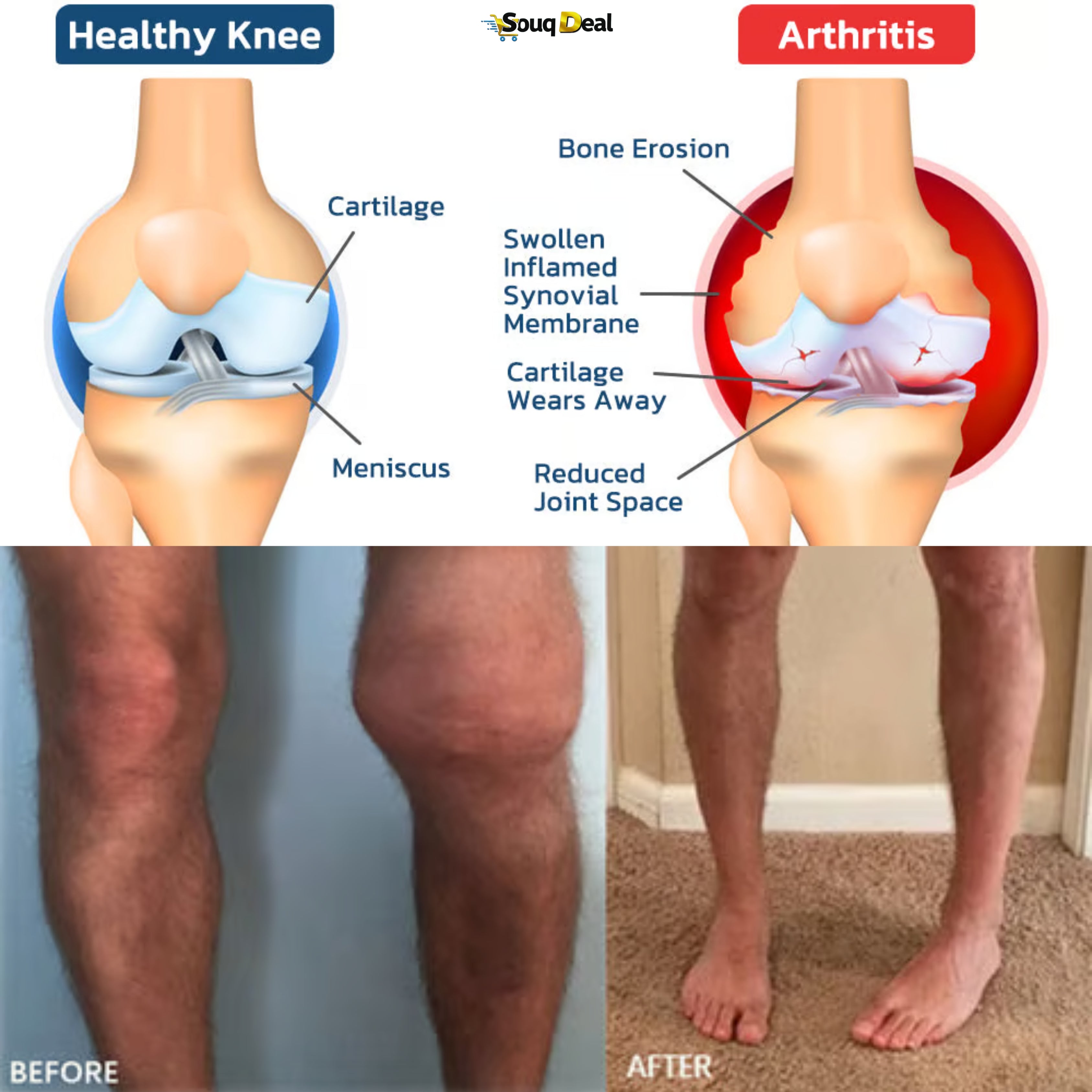 Joint Pain Relief Cream (20g) - Meniscus Pain Relief Ointment